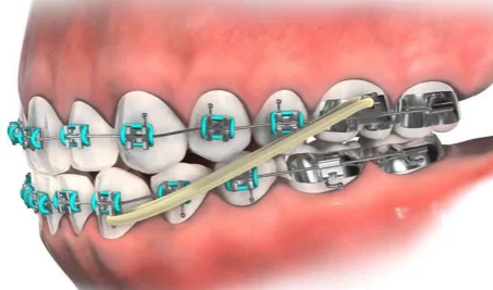 Underbite braces