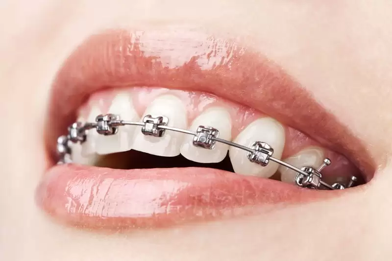 orthodontist hollywood fl